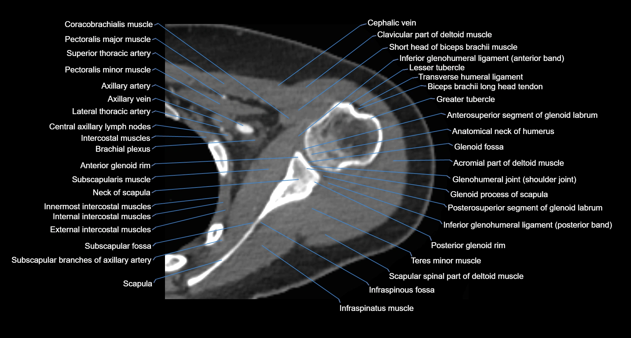 CT Shoulder axial cross sectional anatomy labelled radiology image -00037.webp